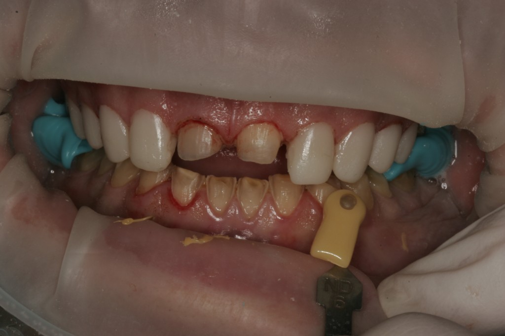 Dental work being done on teeth