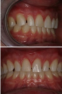 Removed bonding by scaler technique.