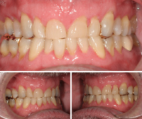 Full Mouth Rehab Treatment Case Photos