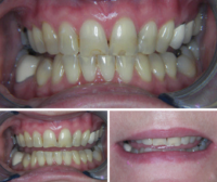 The rewarding aspects of restoring a smile.