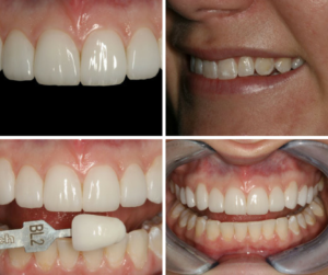 gorgeous results from empress aesthetics veneers