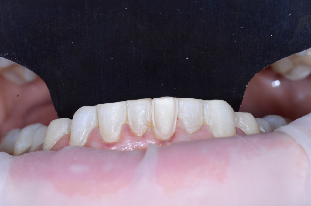 Common alterations for restoring anterior teeth.
