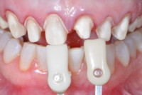 Color change is a typical patient goal with anterior restorations.