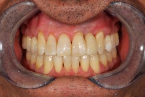 Dr. Chris Catalano Digital Dentistry After