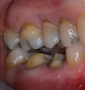 occlusal reduction