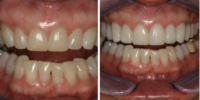 In this Case of the Month, Dr. Hornbrook explains his smile enhancement goals.