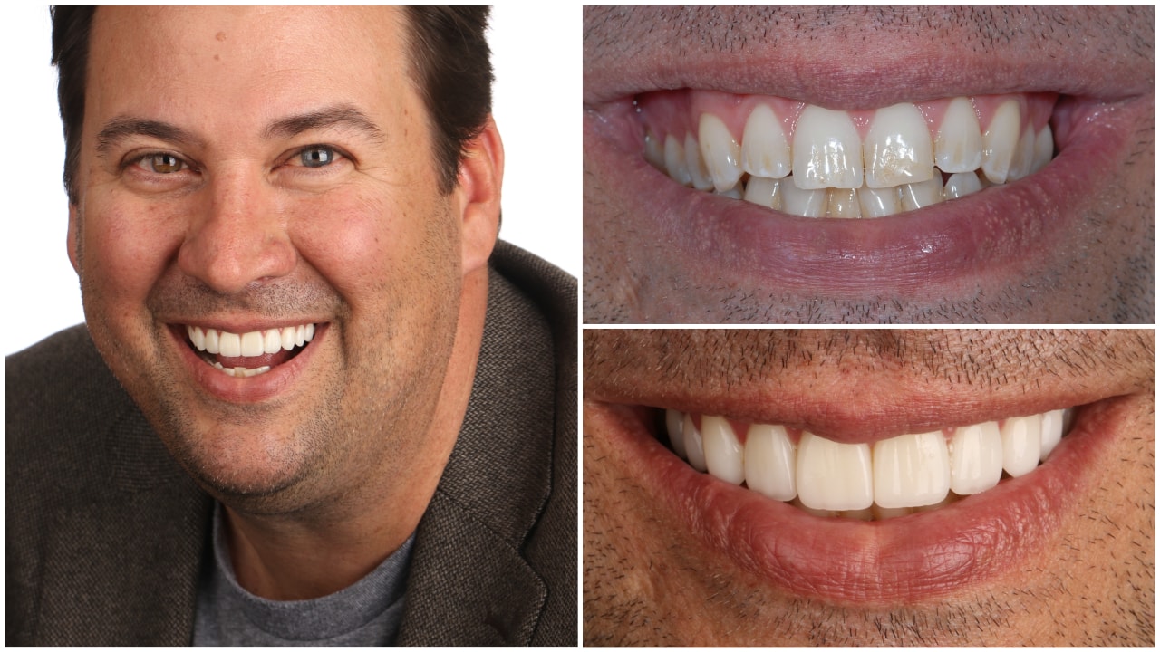 Pete Janicki with before and after smile