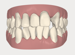 Dr. Chris Catalano Digital Dentistry Case Digital Invisalign 