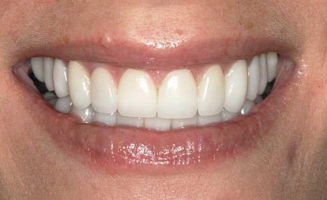 close up white teeth
