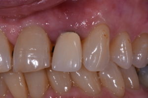 restoring aged or imperfect teeth