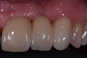 restoring aged or imperfect teeth
