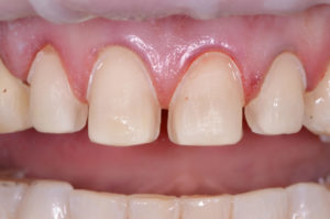 Versatility of ceramic veneers in the dental practice.